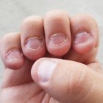 Страшные ногти впоследствии грызения